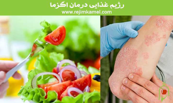 رژیم غذایی درمان اگزما